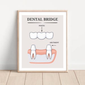 Poster anatomie tandbrug - educatieve kaart over gebitsgezondheid - perfect voor tandheelkundig personeel