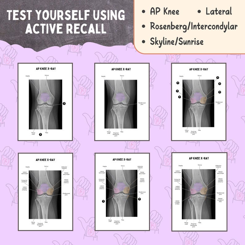 Normal Rosenberg. View Knee X-ray Anatomy, AP Lateral Skyline and Rosenberg Views for Rad ...