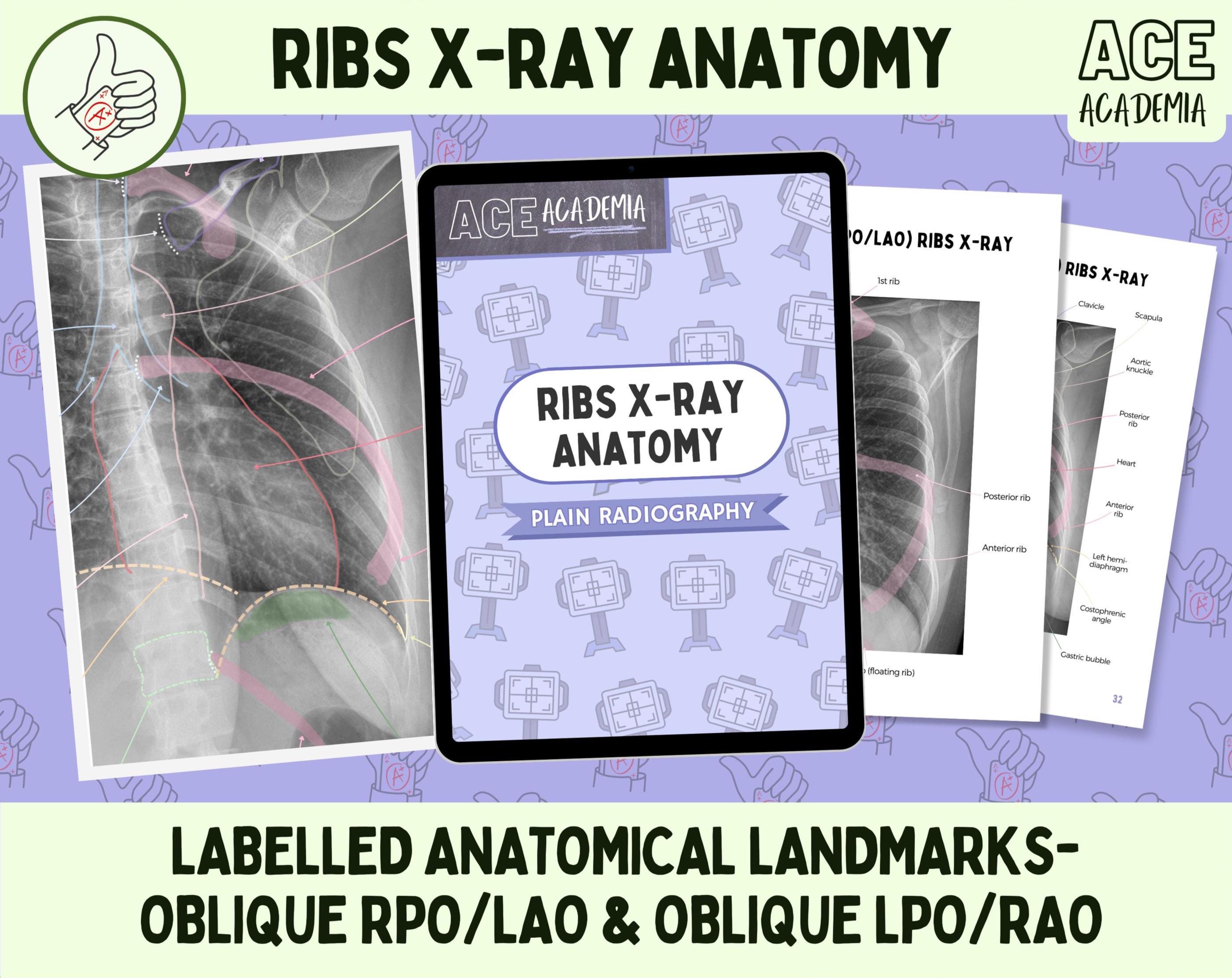 Rib X-ray Anatomy Study: Oblique Views, Labeled Landmarks (PDF) - Etsy