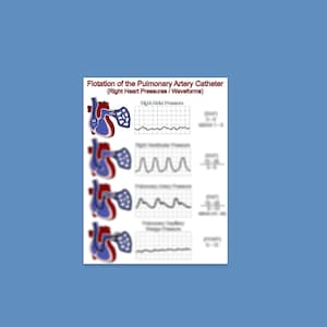 Puede incluir: Un diagrama que muestra la flotación de un catéter de la arteria pulmonar en el ventrículo derecho del corazón. El diagrama muestra el catéter en cuatro posiciones diferentes, con formas de onda correspondientes para la presión auricular derecha, la presión ventricular derecha, la presión arterial pulmonar y la presión de enclavamiento.