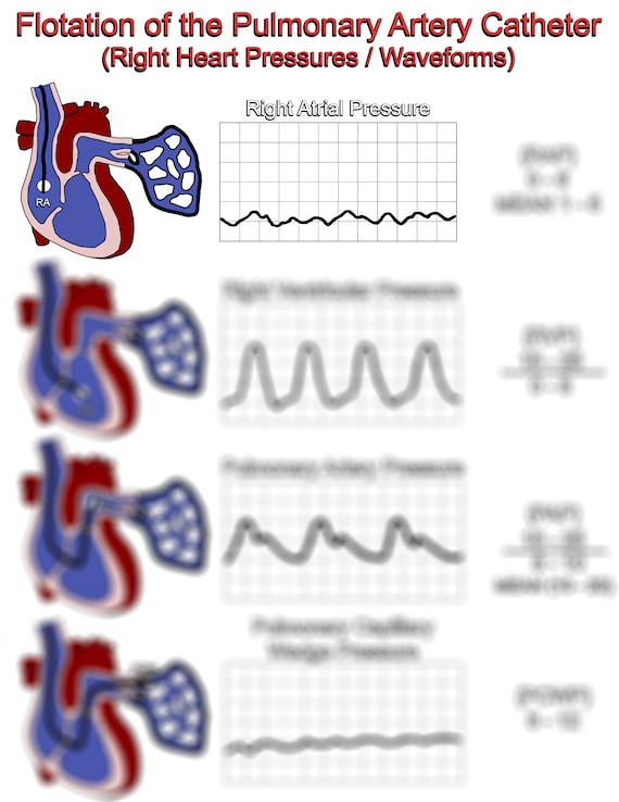 Pulmonary Artery Catheter Waveforms Control Of Cardiac Function