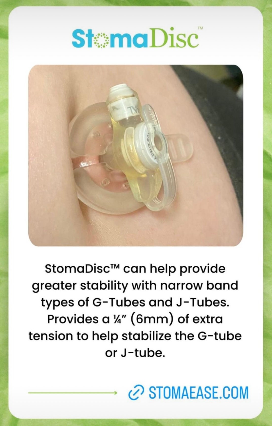 Disc Retainer Stomadisc™ Retainer Disc for the Stomaease™ Powder for Enteral Stomas ...