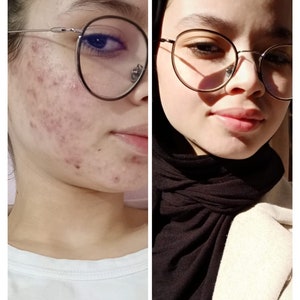 Gamme BIIOskin anti Acné