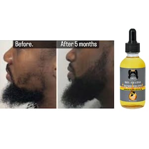 May include: An image shows a side-by-side comparison of a beard before and after 5 months. A bottle of "FAMOUS MEN AMAZING BEARD DROPS" is also shown. The bottle contains a yellow liquid and has a black dropper.