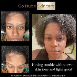 Scale Away Face Cleanser |Relief for dry, itchy face/scalp, Eliminate dead skin, Get Clear Skin, Seborrheic Dermatitis, Eczema, Psoriasis
