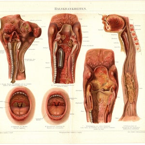 Original 1897 Antique Colour lithography print Neck Surgery Throat mouth larynx and pharynx pathology medicine ENT otorhinolaryngology