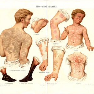 Original 1897 Impresión de litografía en color antiguo Enfermedades de la piel Forúnculos erupción eritema urticaria verrugas condición cutánea úlcera médico medicina dolor