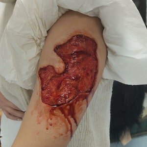 Wound/Ulcer Prosthesis