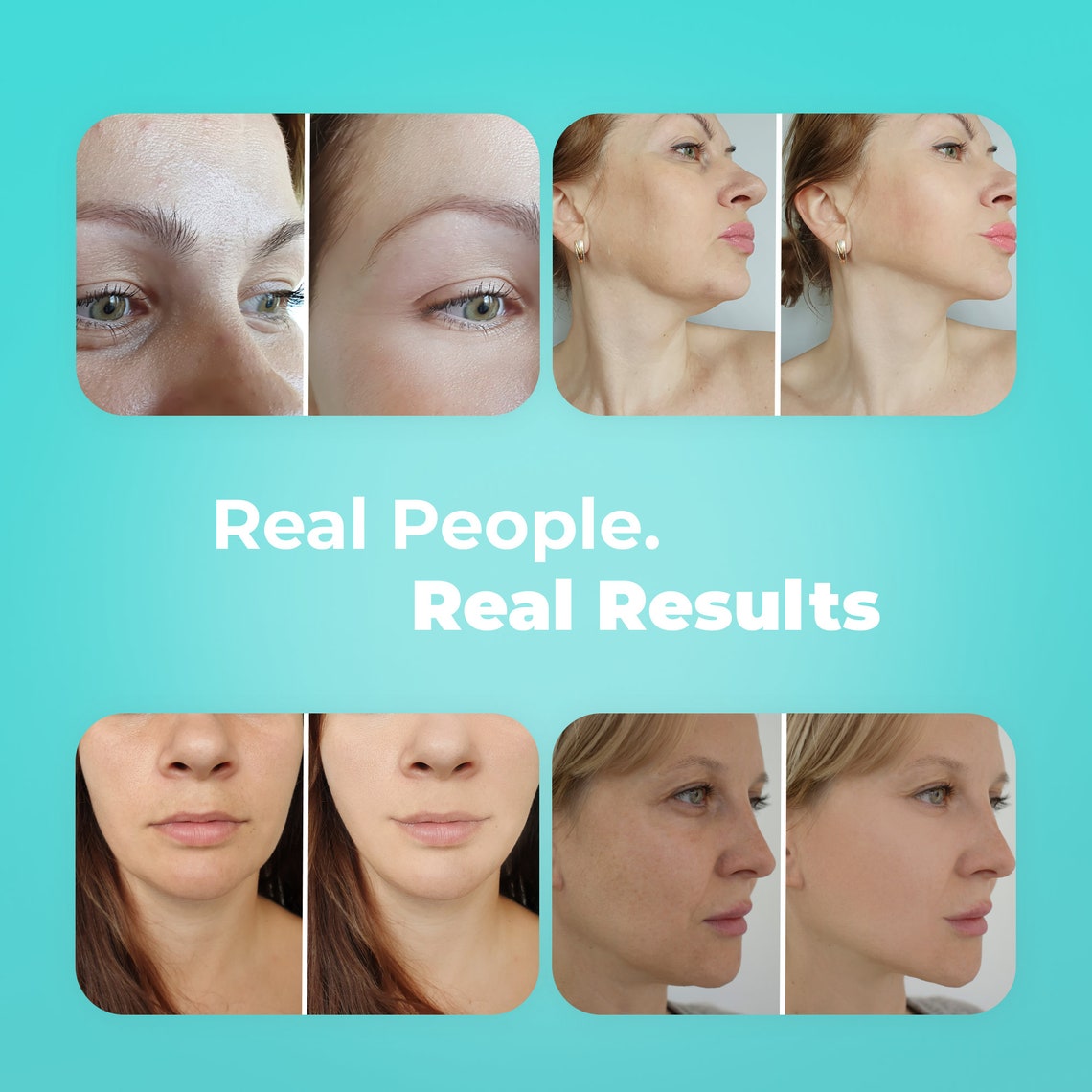 My Derma Dream Microsculpt Microcurrent Facial Device Instant Face Lift