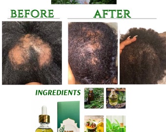 Dash Hair Growth Oil - Advanced Rosemary Oil for Hair Growth - Organics Rosemary Mint Scalp & Hair Strengthening Oil for All Hair Types