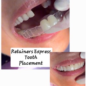 Retainer with Added Teeth (1)You Do not have to smile with missing Front teeth! This is an affordable and undetectable way to fill in teeth.