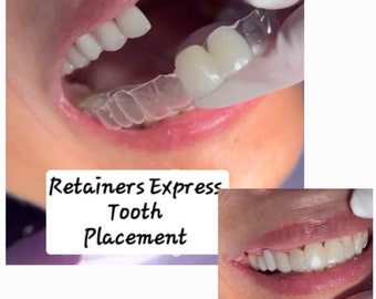 Retainer with Added Teeth (1)You Do not have to smile with missing Front teeth! This is an affordable and undetectable way to fill in teeth.