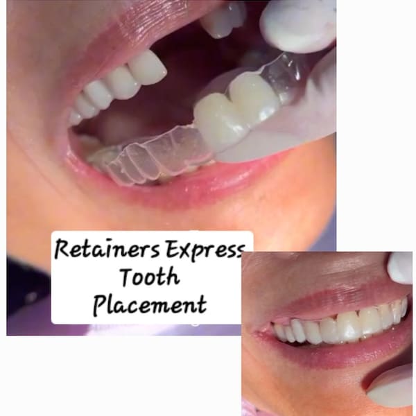 Dispositif de retenue avec dents ajoutées (1) Vous n'avez pas à sourire avec des dents de devant manquantes ! C'est un moyen abordable et indétectable de boucher les dents.