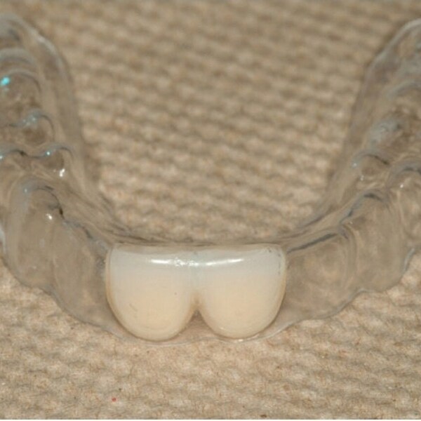 Dispositif de retenue avec dents ajoutées, jusqu'à 4 en 1 arrière) Il vous manque des dents de devant ! C'est un moyen abordable et indétectable de boucher les dents.