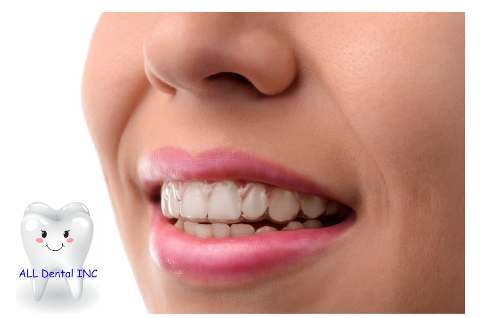 Clear Ortho Aligners /ortho Retainers/ Custom Trays/ Splint/ Custom