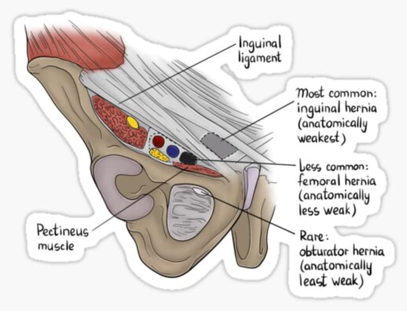 anatomy-hernia-sticker-medical-student-study-aid-etsy