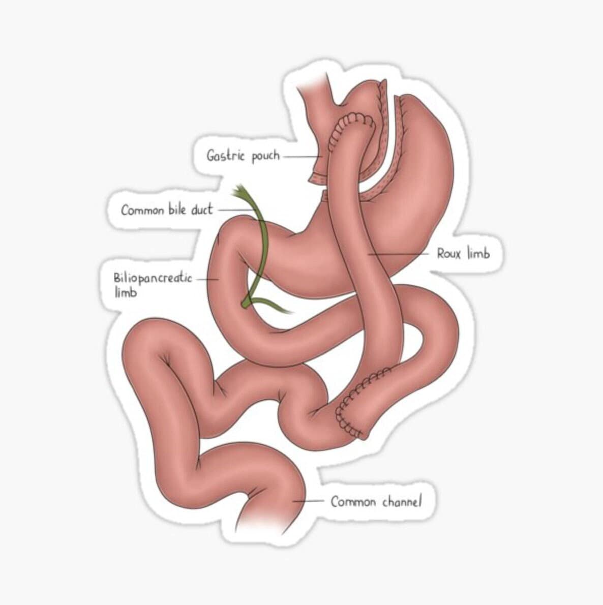 Pegatina de anatomía del bypass gástrico: herramienta de