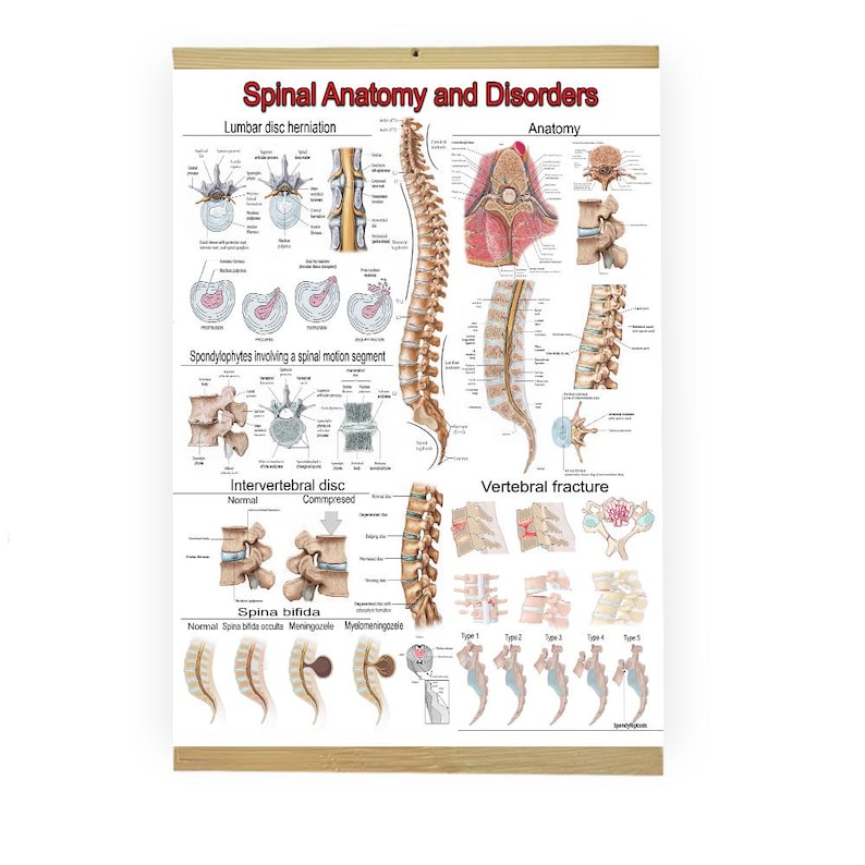 Spine Anatomy Poster Set – Spinal Disorders, Vertebral Chart - Etsy ...