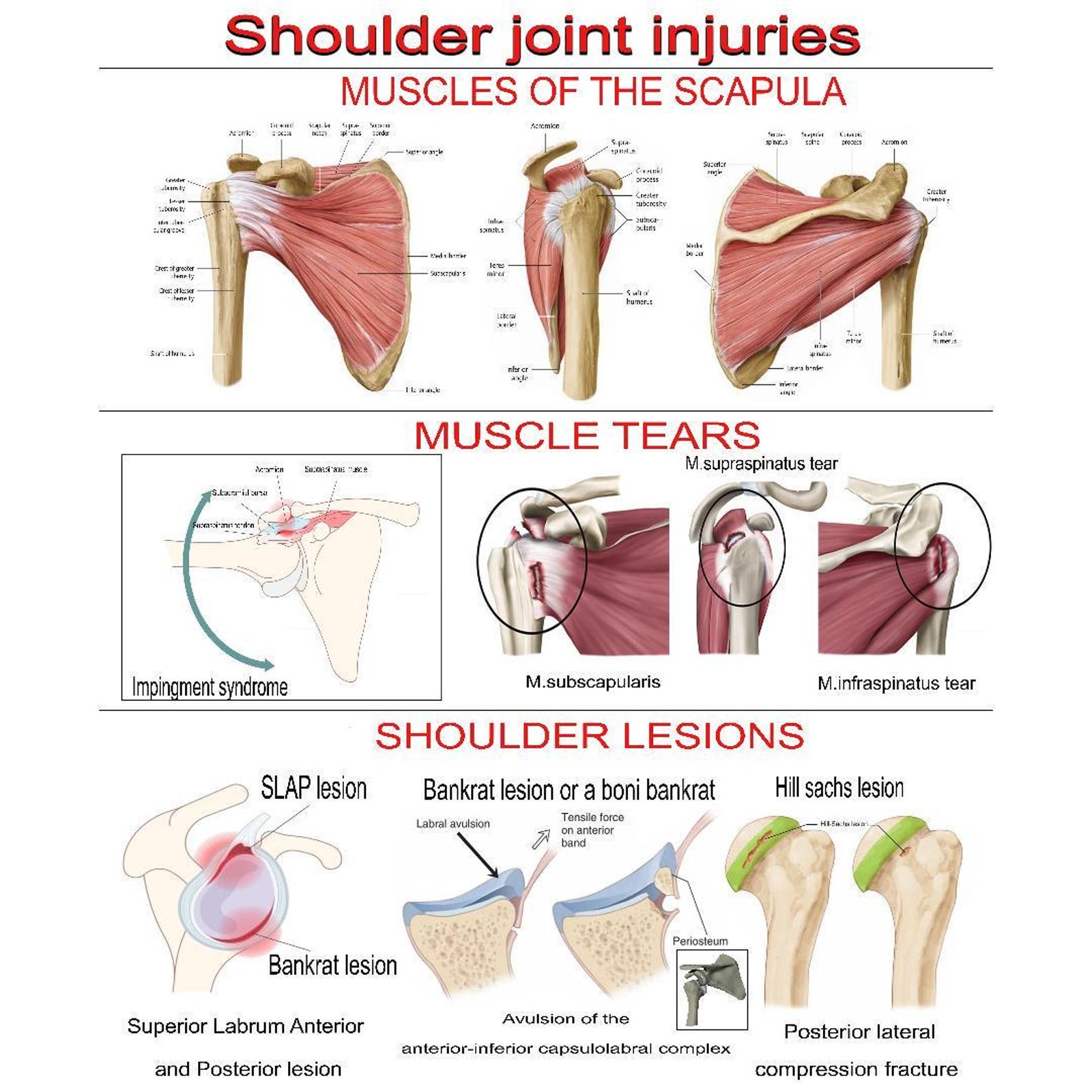 Shoulder Joint Injuries Poster – Muscles, Tears & Lesions | Anatomy ...