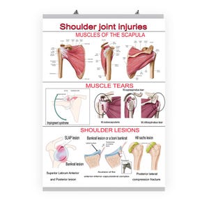 May include: A medical poster illustrating shoulder joint injuries, including muscle tears and lesions. The poster features detailed anatomical diagrams of the scapula and shoulder joint, with labels and text describing various conditions.