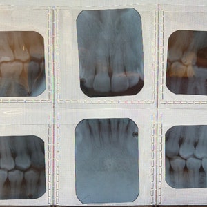 Vintage Dental X-rays
