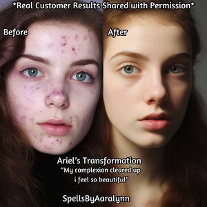 May include: Before and after photos of a person's face. The before photo shows acne and blemishes. The after photo shows clear skin. The text reads "Ariel's Transformation "My complexion cleared up i feel so beautiful" SpellsByAaralynn"
