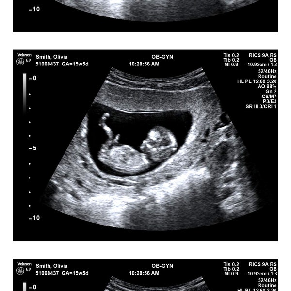 Ultrasound Picture - Etsy