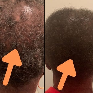 Scalp Detox Bundle