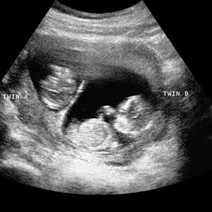 Personalized Prank Twin Pregnancy Realistic Black and White Ultrasound