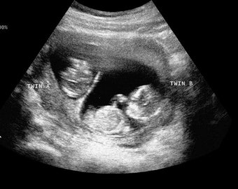 Personalized Prank Twin Pregnancy Realistic Black and White Ultrasound