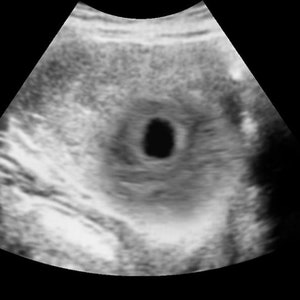 Broma personalizada Aborto espontáneo temprano Ultrasonido realista en blanco y negro imagen 1