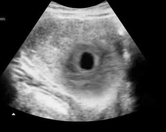 Personalized Prank Early Miscarriage Realistic Black and White Ultrasound