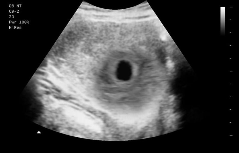 Personalized Prank Early Miscarriage Realistic Black and White Ultrasound image 1