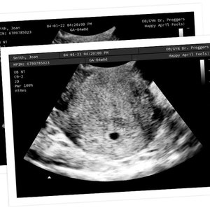 Personalized Prank Early Miscarriage Realistic Black and White Ultrasound image 2