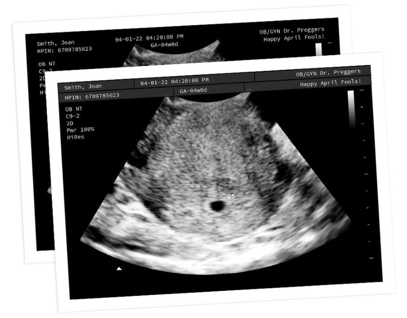 Personalized Prank Early Miscarriage Realistic Black and White Ultrasound image 2