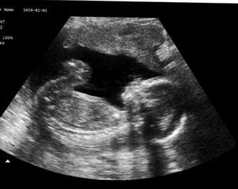 Personalized Prank Pregnant Realistic Black and White Ultrasound