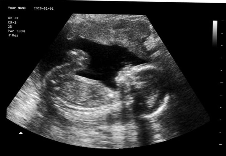 Personalisierter Streich schwangerer realistischer Schwarz-Weiß-Ultraschall Bild 1