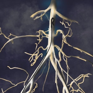 May include: A digital illustration of a branching network of veins and arteries, with a thin black line running through the center.