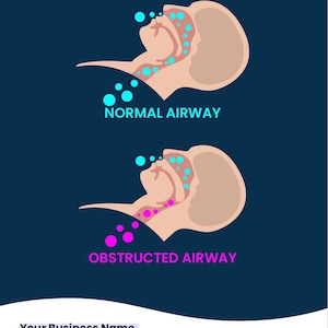 Fillable Sleep Apnea Airway Poster 18x24 Size