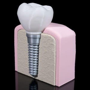 May include: A dental implant model featuring a white tooth crown attached to a silver-coloured threaded metal post. The post is embedded into a beige, textured block representing bone, which is encased in a smooth, light pink gum-coloured frame.