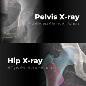 Può includere: Un'immagine a raggi X in bianco e nero di un bacino e un'anca con linee anatomiche disegnate su di essa. Il testo "Pelvis X-ray Anatomical lines included" è nella parte superiore dell'immagine. Il testo "Hip X-ray AP projection included" è nella parte inferiore dell'immagine.