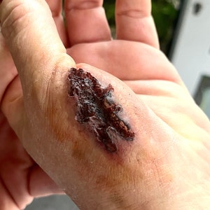 flesh wound
