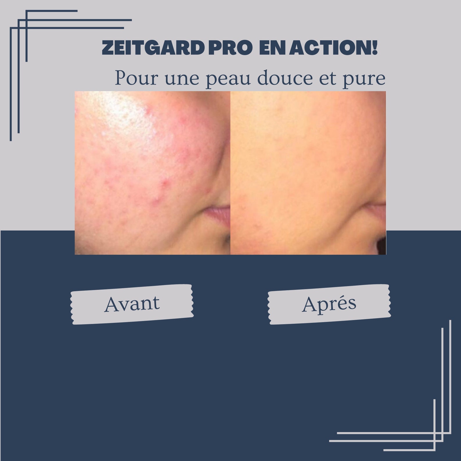 Appareil De Soin Visage Zeitgard Pro Complet - Brosse Faciale électrique LR - Neuf Sous Blister