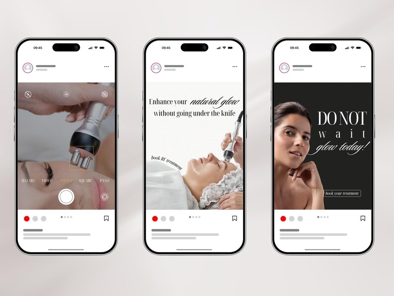 May include: Three smartphones displaying social media posts about radio frequency skin treatments. The screens show a camera interface, a person receiving a facial treatment with a handheld device, and a promotional graphic with the text DO NOT WAIT glow today!