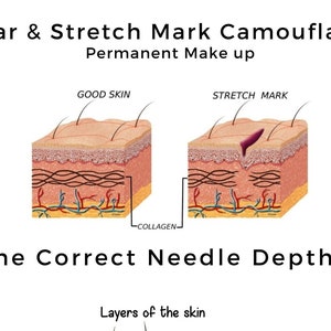 Könnte beinhalten: Diagramm, das die Hautschichten zeigt, mit einer Nahaufnahme einer Dehnungsstreifen und einem normalen Hautbereich. Der Text lautet "Scar & Stretch Mark Camouflage Permanent Make up" und "The Correct Needle Depth?"