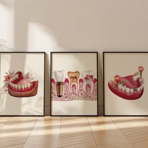 Könnte beinhalten: Drei gerahmte Illustrationen von Zähnen und Zahnersatz. Die erste Illustration zeigt einen Satz von Zahnersatz mit rosa Zahnfleisch und Blumen. Die zweite Illustration zeigt eine Nahaufnahme eines Zahns mit einem Zahnimplantat. Die dritte Illustration zeigt einen Satz von Zahnersatz mit rosa Zahnfleisch und Blumen.