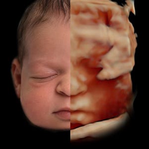 May include: A split-screen composite image featuring the left side of a newborn infant's face with smooth skin and closed eyes, contrasted against the right side showing a three-dimensional ultrasound scan of a fetal face in reddish-orange tones.