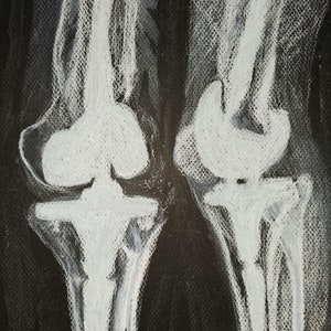 May include: A black and white chalk drawing of two human knee joints on a black background.