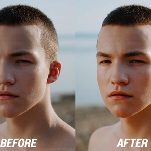 Puede incluir: Imagen dividida que muestra el rostro de una persona antes y despu&eacute;s de un procedimiento cosm&eacute;tico. El texto "ANTES" est&aacute; en la parte inferior izquierda y "DESPU&Eacute;S" en la parte inferior derecha. La persona tiene el pelo corto y oscuro y mira hacia adelante.