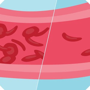 Puede incluir: Ilustración de un corte transversal de un vaso sanguíneo. El lado izquierdo muestra un vaso con coágulos de sangre, mientras que el lado derecho representa un vaso sano con células sanguíneas que fluyen libremente. El fondo es un círculo azul claro.